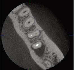 Tomografia 3D endo- T~o specjalny tryb tomografi który wykorzystywany jest w ocenie przebiegu kanałów korzeniowych.