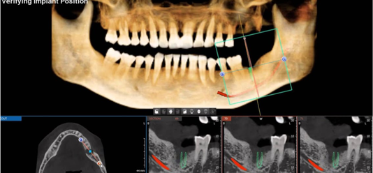 Tomografia stożkowa 3D – pełne możliwości diagnostyczne