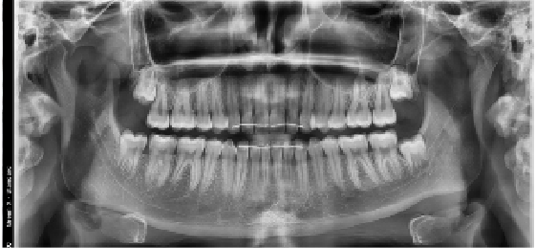 Panorama, zdjęcie pantomograficzne to obrazowanie które pomaga na ocenę stanu zębów oraz kości.